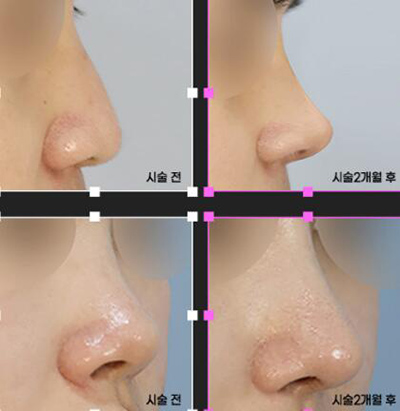 韩国UcanB整形外科隆鼻照片