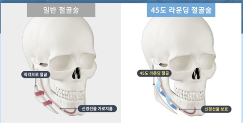 韩国绮林整形医院45度旋转截骨术与常规截骨对比