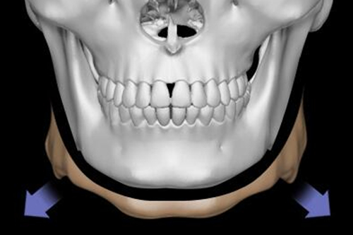 韩国H整形外科医院下颌角手术展示