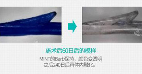 韓國秀美顏整形外科面部埋線材料展示 韓國秀美顏整形外科面部埋線材料展示