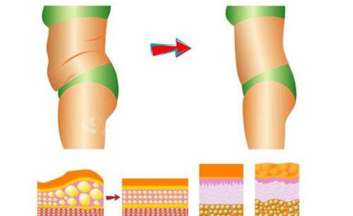 腰腹吸脂原理图片