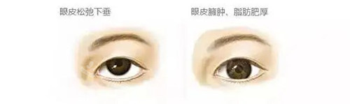 眼皮松弛圖片