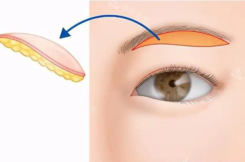 提眉手術示意圖