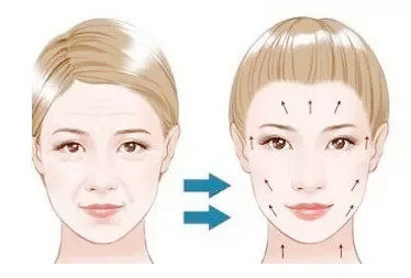 韩国丽延长V型脸提升术,5种蛋白线综合使用提升作用大不同