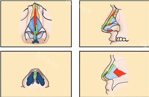 隆鼻示意图