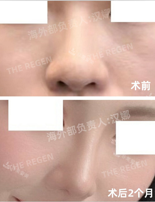 韩国德丽珍整形外科隆鼻照片