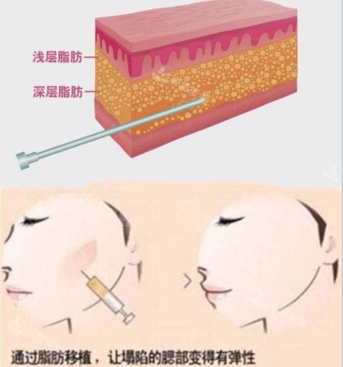 脂肪填充 脂肪填充