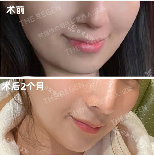 韓國JN整形埋線手術(shù)前后照片 韓國JN整形埋線手術(shù)前后照片