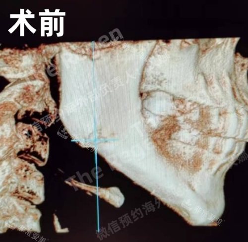 術(shù)前 術(shù)前