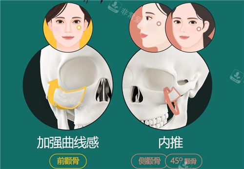 顴骨顴弓手術(shù)方式示意圖 顴骨顴弓手術(shù)方式示意圖