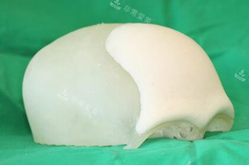 韓國(guó)H整形外科醫(yī)院眉骨手術(shù)