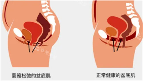 盆底肌前后对比图