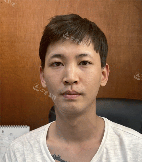 韩国优雅人整形外科男士眼鼻整形手术前