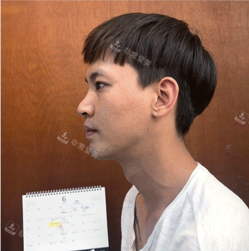 韓國(guó)優(yōu)雅人隆鼻前側(cè)面照片 韓國(guó)優(yōu)雅人隆鼻前側(cè)面照片