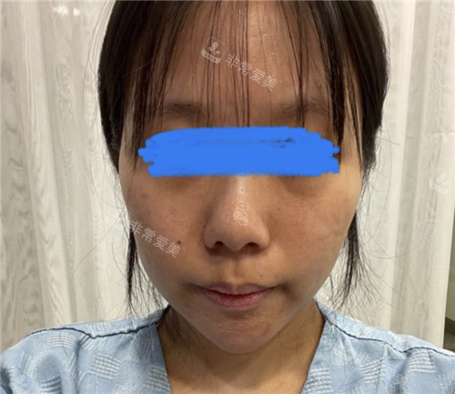 立體整形外科顴骨手術(shù)術(shù)前 立體整形外科顴骨手術(shù)術(shù)前