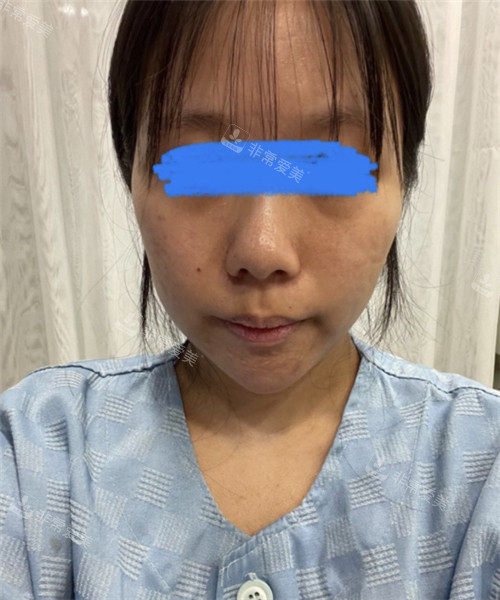 立體整形外科顴骨整形術(shù)前圖 立體整形外科顴骨整形術(shù)前圖