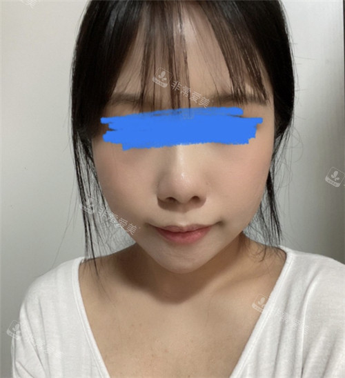 立體整形外科顴骨整形術(shù)后圖 立體整形外科顴骨整形術(shù)后圖