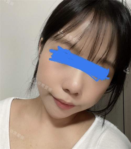 立體整形外科顴骨整形術(shù)后展示 立體整形外科顴骨整形術(shù)后展示