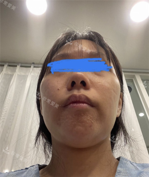 立體整形外科顴骨整形術(shù)前情況 立體整形外科顴骨整形術(shù)前情況