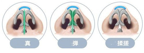 隆鼻筆尖示意圖 隆鼻筆尖示意圖