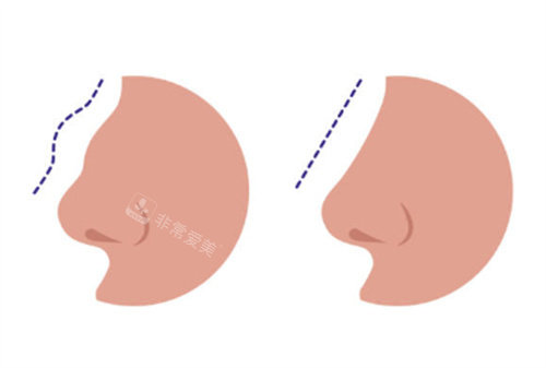 驼峰鼻矫正示意图