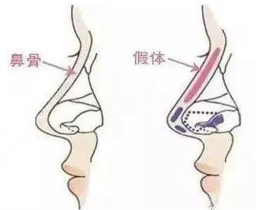 鼻部假体放置示意图