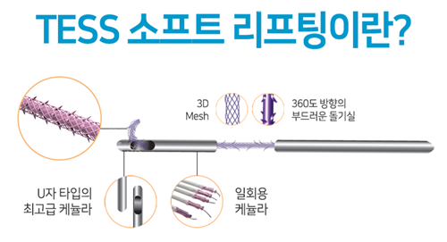 TESS提升術解析圖示 TESS提升術解析圖示