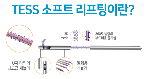 TESS提升术解析图示