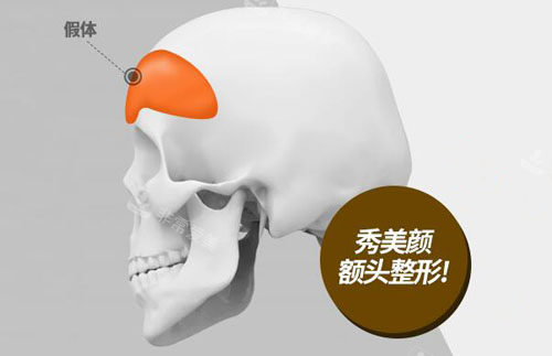 韓國秀美顏整形額頭假體部位放置圖 韓國秀美顏整形額頭假體部位放置圖