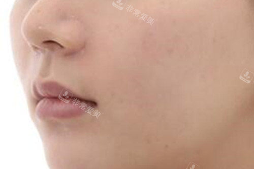 韓國(guó)H整形外科醫(yī)院上唇外翻手術(shù)反饋