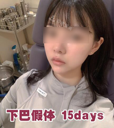 韩国UcanB整形外科15天展示