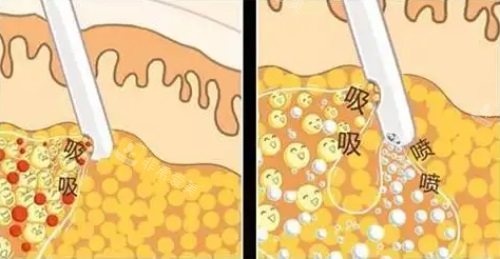 吸脂 吸脂