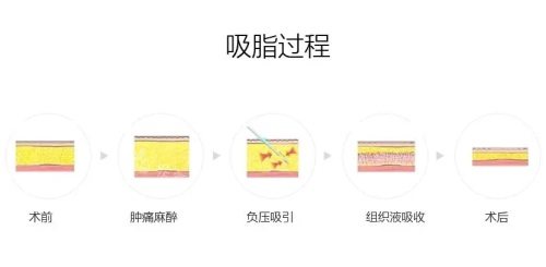 吸脂過程 吸脂過程
