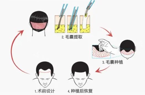 植發(fā)過程