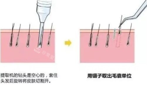 提取毛囊過程