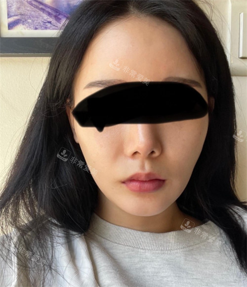 立體整外科形輪廓整形術(shù)前圖 立體整外科形輪廓整形術(shù)前圖