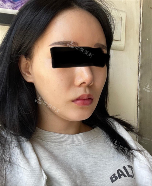 立體整外科形面部輪廓整形術(shù)前圖 立體整外科形面部輪廓整形術(shù)前圖