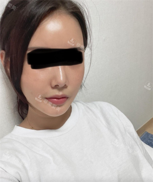 立體整外科形顴骨整形手術(shù)術(shù)后圖 立體整外科形顴骨整形手術(shù)術(shù)后圖