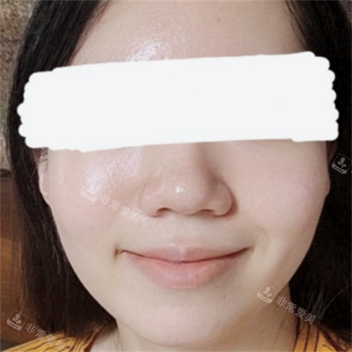 韓國IPCHEA立體整形外科鼻翼縮小術(shù)前 韓國IPCHEA立體整形外科鼻翼縮小術(shù)前