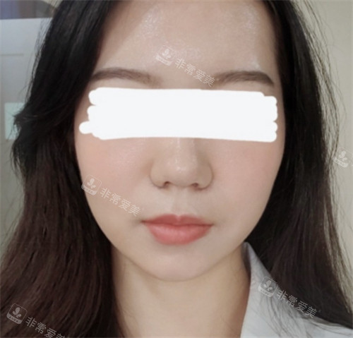 韓國IPCHEA立體整形外科鼻翼縮小術(shù)后 韓國IPCHEA立體整形外科鼻翼縮小術(shù)后