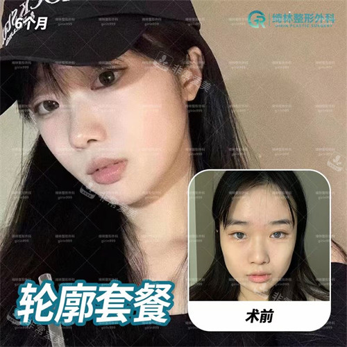 韓國(guó)綺林整形外科輪廓整形前后圖 韓國(guó)綺林整形外科輪廓整形前后圖