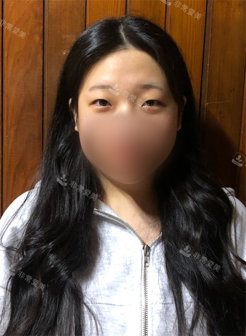 韩国朵医院埋线双眼皮+提肌手术前
