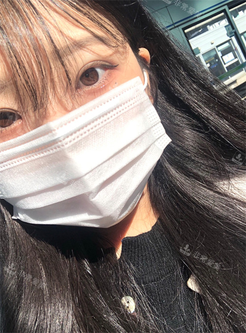 韩国朵医院埋线双眼皮+提肌手术后