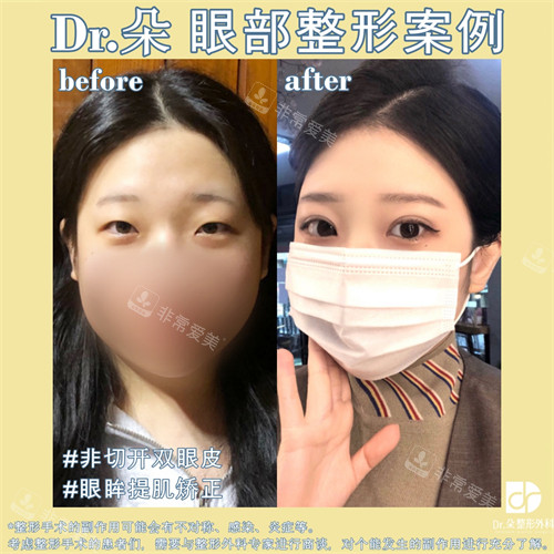 韓國(guó)朵醫(yī)院埋線雙眼皮+提肌手術(shù)后 韓國(guó)朵醫(yī)院埋線雙眼皮+提肌手術(shù)后
