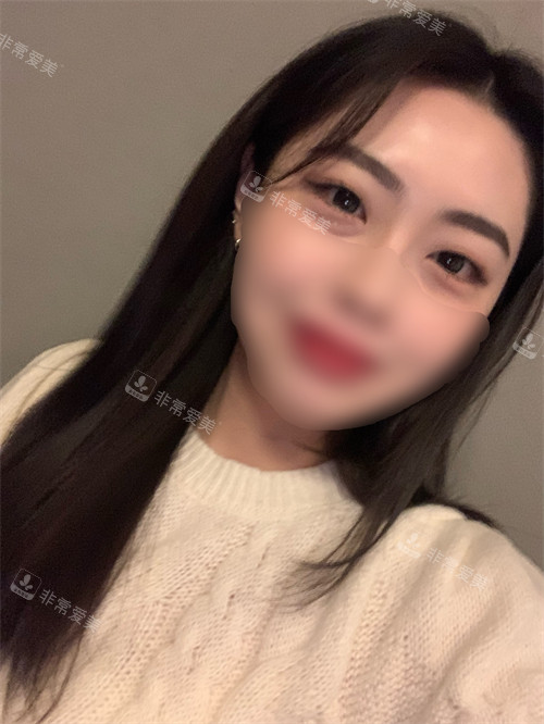埋線雙眼皮祛眼袋術(shù)前圖 埋線雙眼皮祛眼袋術(shù)前圖