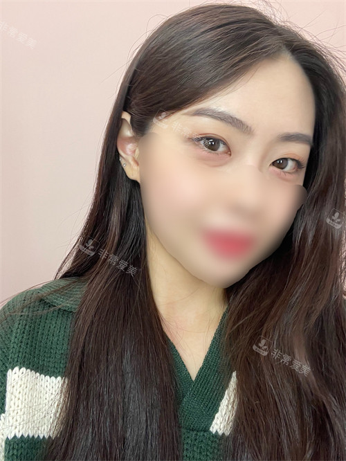 埋線雙眼皮祛眼袋術(shù)前圖 埋線雙眼皮祛眼袋術(shù)前圖