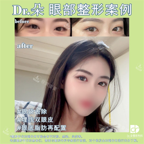 埋線雙眼皮祛眼袋前后對(duì)比照 埋線雙眼皮祛眼袋前后對(duì)比照