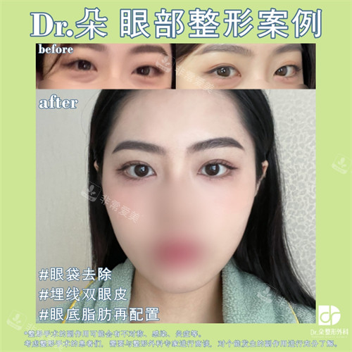埋線雙眼皮祛眼袋前后對(duì)比照 埋線雙眼皮祛眼袋前后對(duì)比照