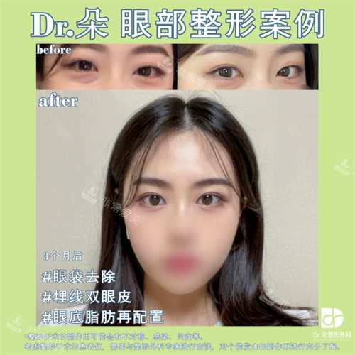 雙眼皮眼底脂肪重置會(huì)怎么樣圖示 雙眼皮眼底脂肪重置會(huì)怎么樣圖示