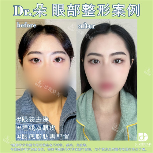 韓國(guó)朵醫(yī)院雙眼皮眼底脂肪重置前后對(duì)比圖 韓國(guó)朵醫(yī)院雙眼皮眼底脂肪重置前后對(duì)比圖